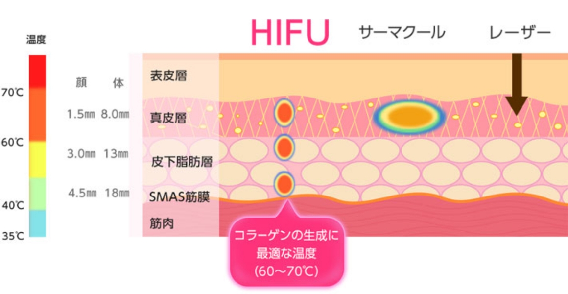 HIFUの原理